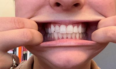 ‘I woke up and it was no longer a company’: SmileDirectClub’s closure leaves customers in the lurch