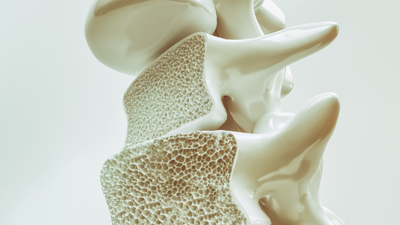 How to prevent and manage Osteoporosis through smart eating habits