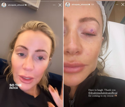 Loose Women’s Olivia Attwood forced to pull out of Christmas party due to injury