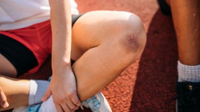 What causes bruising?