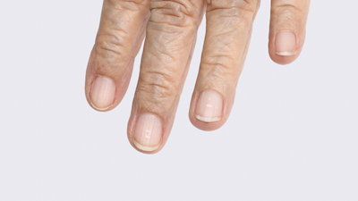 Symptoms and treatment of calcium deficiency in adults