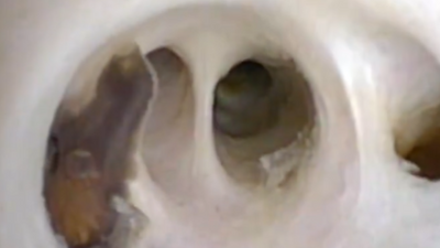 5 live worms found wriggling inside 70 year old man's abdomen: Here's what happened