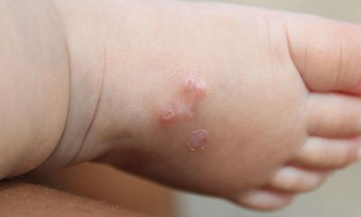 Doctors report ‘nightmare’ surge in scabies across UK