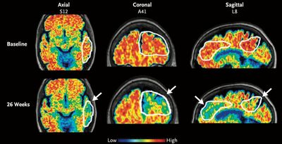 Alzheimer's drugs might get into the brain faster with new ultrasound tool, study shows