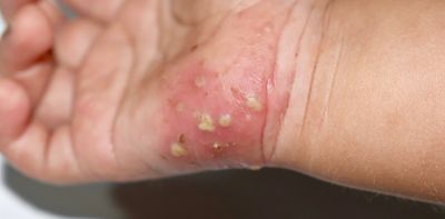 Scabies: UK facing unusually large outbreaks – and treatment shortages appear mostly to blame