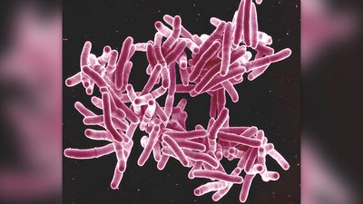 2nd tuberculosis outbreak linked to bone grafts in the US