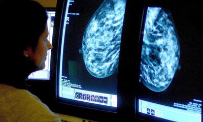 Cost of breast cancer to UK economy could reach £3.6bn by 2034, study shows