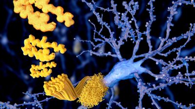 Alzheimer's is transmissible in extremely rare scenarios