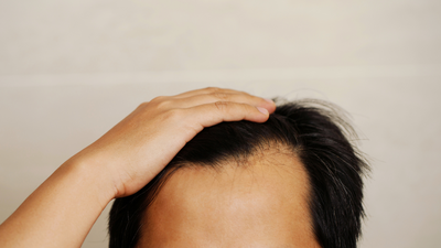 5 causes of baldness in men and how to treat it