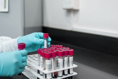 Simple Blood Test Can Predict Risk Of Heart Attack In Next 6 Months