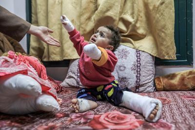 The toddler amputees of Israel’s war on Gaza – Hoor Nusseir
