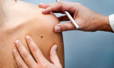 Lockdown diagnosis delays caused jump in skin cancer deaths, study suggests