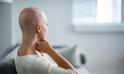 Drug to treat alopecia recommended for NHS use for first time