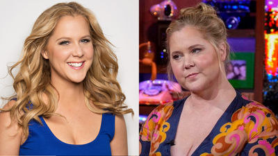 Amy Schumer has Cushing syndrome: All about the condition that caused fans to question her 'puffy' face