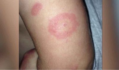 Lyme disease reported in Kerala's Ernakulam