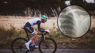 I broke my collarbone (twice) and learned that cycling expects people to 'spring back' far too quickly