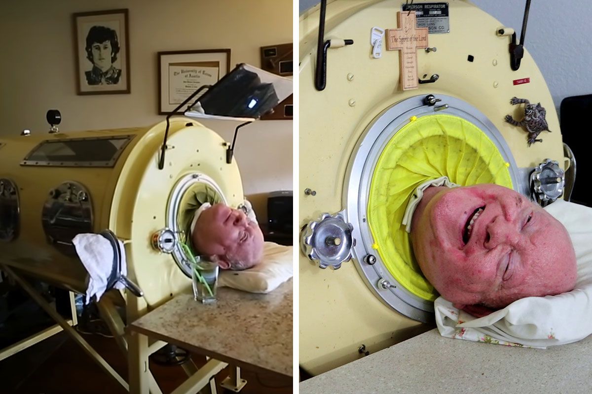 Paul Alexander, Man Who Lived Inside Iron Lung For 70…