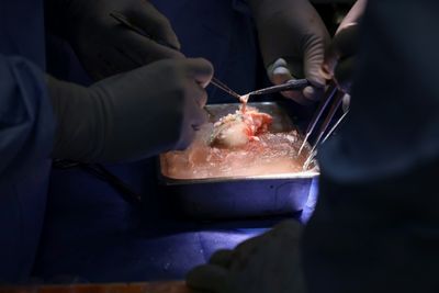 US Surgeons Transplant Pig Kidney To Live Patient In World First