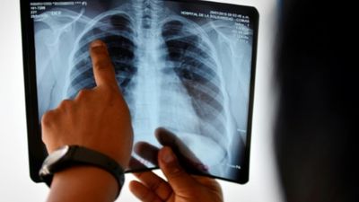 After a lull during Covid, France sees rise in tuberculosis cases