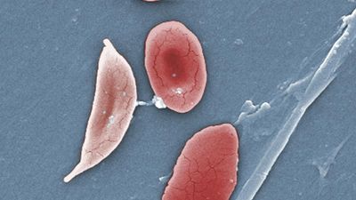 How subpar treatment options allow sickle cell disease to persist | Explained