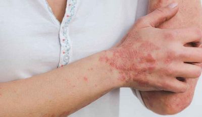 Technology: How gene mutation responsible for causing psoriasis
