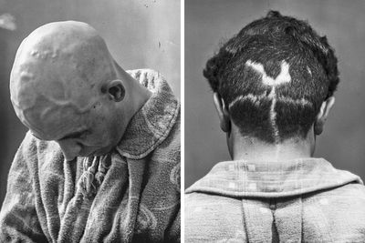 20 Haunting Medical Portraits Of Harvey Cushing’s Patients In The Early 20th Century