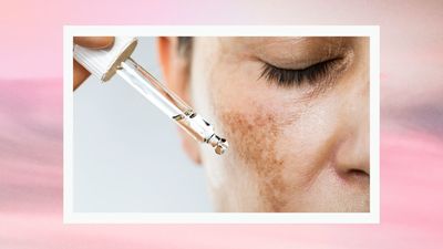 What are hyaluronic acid fillers and can you get hyaluronic acid injections in your face?
