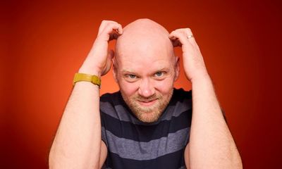 Losing my hair made me miserable. Now I’m as bald as an egg, I couldn’t be happier