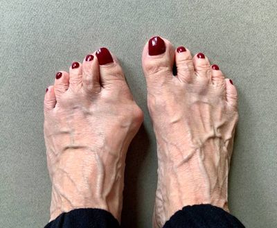 Dr. Richard Moy's Proprietary Technique for Painless Bunion Surgery