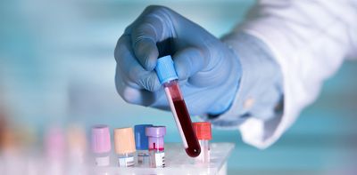 Multiple sclerosis: blood test that tracks immune response could be first step in developing better treatments