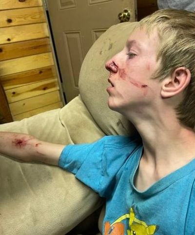 Teen survives terrifying bear attack thanks to his brother