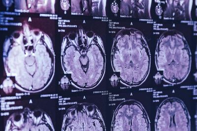 Top Canadian scientist alleges in leaked emails he was barred from studying mystery brain illness