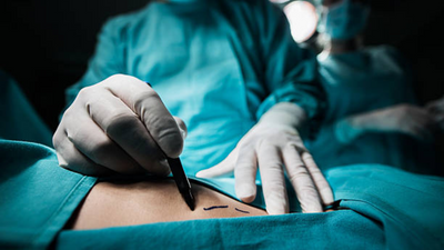 Liposuction myths vs. facts: Separating reality from fiction