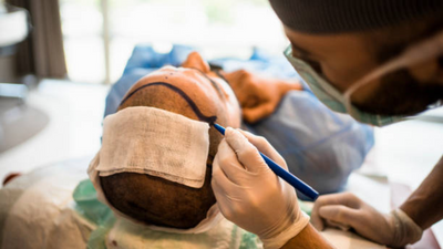 The millennial surge in hair transplants: India's flourishing trend