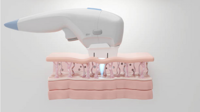 What is Ultherapy? Everything about the non-invasive skin tightening process