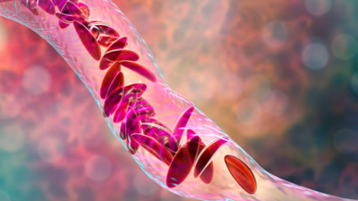 How sickle cell disease is a huge burden upon India’s public health