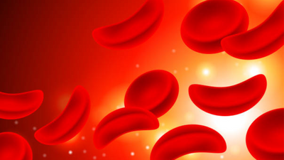 Sickle Cell Disease: Symptoms, risks and understanding those living with sickle cell disease