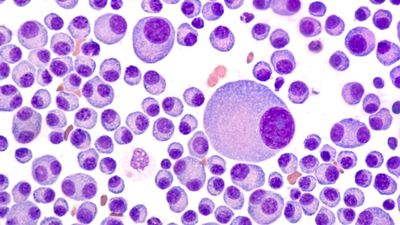 Complex blood cancer on the rise in Australia