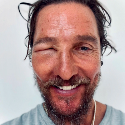 Matthew McConaughey Shares Photo of Bee Sting That Made His Eye Swell Shut