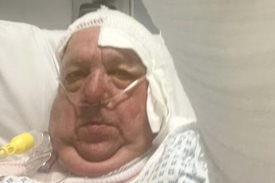 'If You Think Electric Cars Are Safe, Think Again': Man Suffers 60% Burns After Rescuing Granddaughter From Volvo EV That Suddenly Exploded