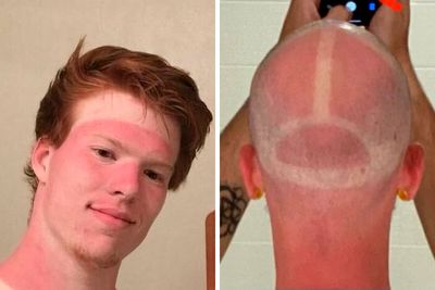 50 Times People Posted Their Embarrassing Sunbathing Fails So You Can Learn From Their Mistakes