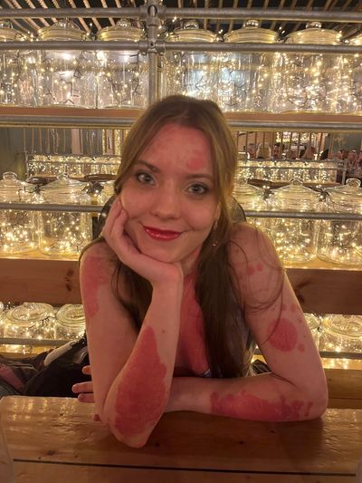 The influencers living with Psoriasis – and what they want you to know about the condition