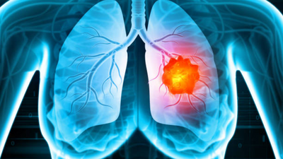 No cough, still cancer? Exploring lung cancer signs