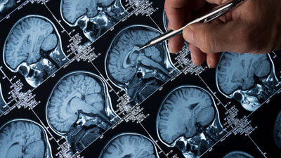 Awake Brain Surgery: Revolutionizing neurosurgery with precision and care
