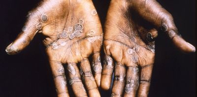 Mpox cases are soaring in Africa – what must be done to prevent a global pandemic