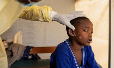 UK prepares for mpox cases after global emergency declared