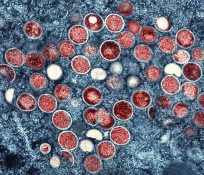 Sweden Reports First Case Of Highly-Infectious Mpox