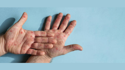 Monkeypox virus detected in Pakistan: 3 cases identified so far