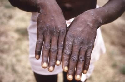 Global Health Emergency Declared For Deadly Mpox Outbreak