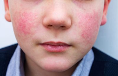 Parvovirus B19 is spreading across the U.S. What to know about the disease that causes ‘slapped cheek’ rash in children